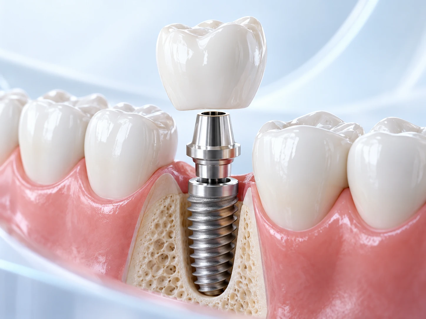 Render 3D de implante de titânio no osso, com pilar e coroa dentária